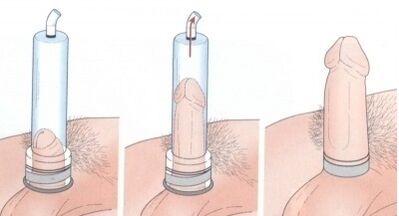 Aumento do pênis usando uma bomba